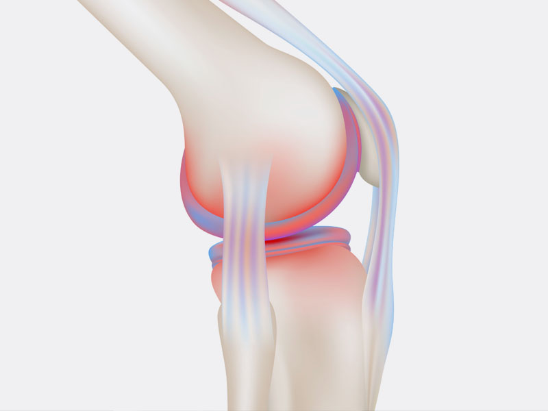 inflitracao-acido-hialuronico-no-joelho-rio-de-janeiro-desgaste-cartilagem1