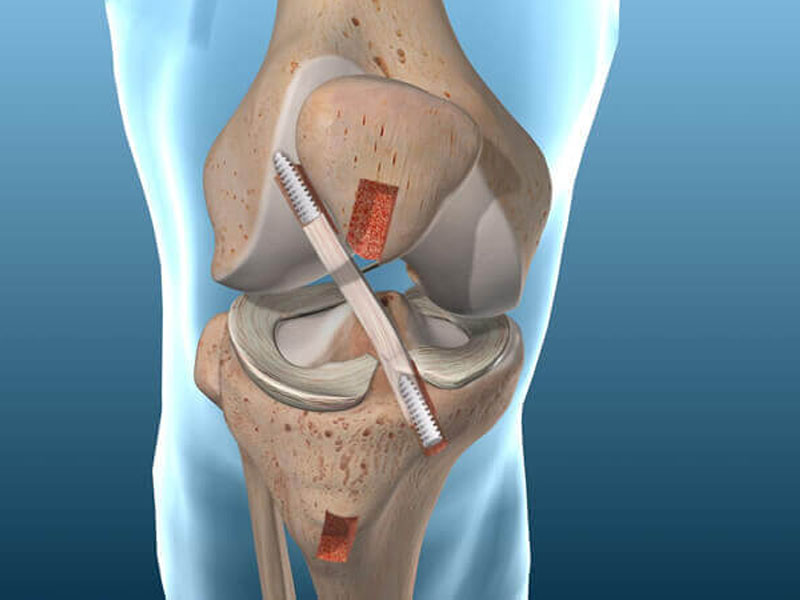 inflitracao-acido-hialuronico-no-joelho-rio-de-janeiro-pos-operatorio-joelho